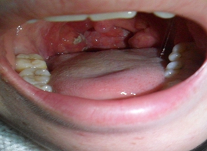 of pharynx)为咽部淋巴组织异常角化,多发生于腭扁桃体及舌扁桃体,咽