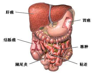 剖腹探查术可用于诊断:*急性阑尾炎;*急性或慢性胰腺炎;*腹膜后,腹部