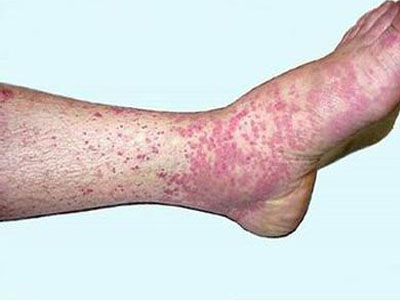 临床特点为皮肤细小的瘀点及大小不等的瘀斑,常见于下肢及臂部,反复