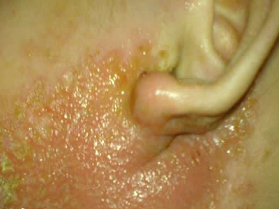 宝宝耳部湿疹的图片图片