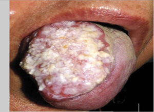 口腔乳头瘤图片