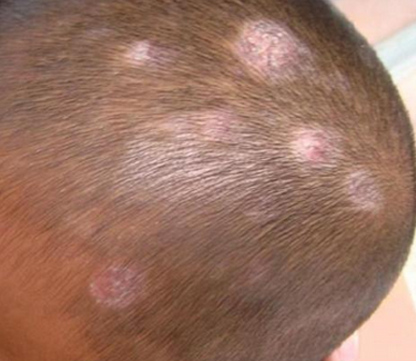 头癣是皮肤癣菌感染头皮及毛发所致的疾病好发于儿童,成人很少感染