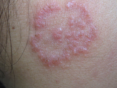 梅毒环形红斑图片图片