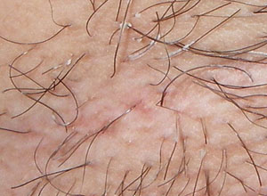 皮肤毛霉菌病图片图片
