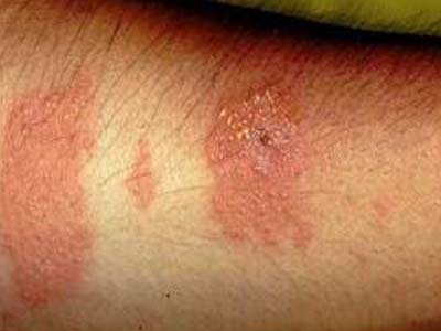 血吸虫尾蚴性皮炎是指禽,畜类血吸虫的尾蚴侵入人体皮肤引起的一种
