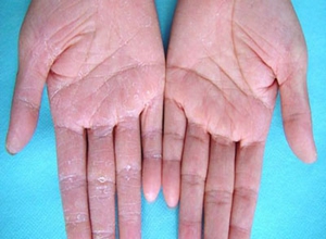 手足角质硬化症图片图片