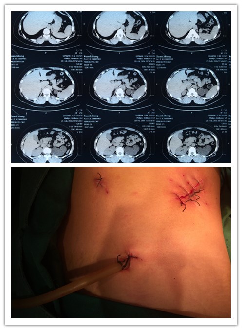 後腹腔鏡下無功能腎切除術