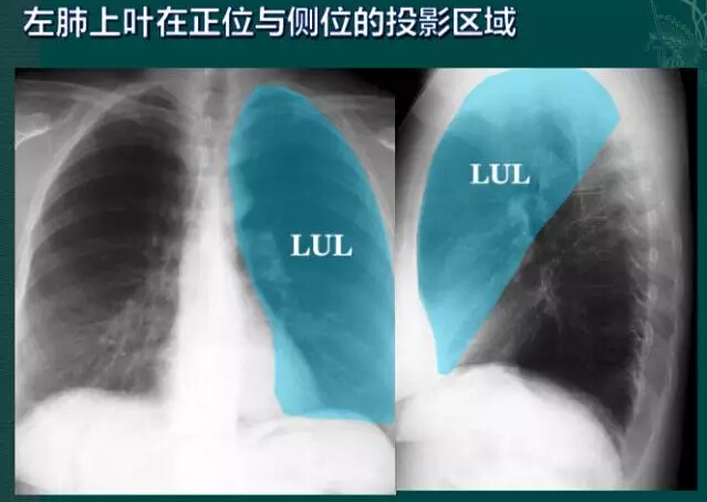 看完此文,終於學會看胸片了! 健康頭條 移動版