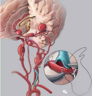 腦血管堵塞微創手術後支架 腦血管支架手術後多久危險期