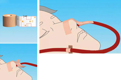 胃管鼻贴怎么剪 图片图片