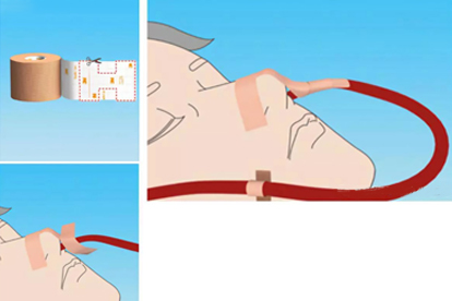 怎样固定胃管鼻贴图片图片