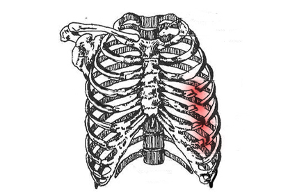 右侧肋骨4567骨折图