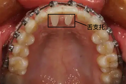 舌隆突支托图片图片