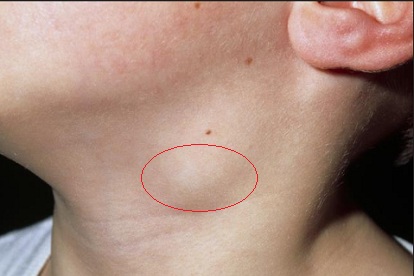 颈部淋巴结瘤的图片图片