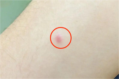 蚊虫叮咬:被蚊虫叮咬后可能会出现丘疱疹,红丘疹等症状,如果自身抵抗
