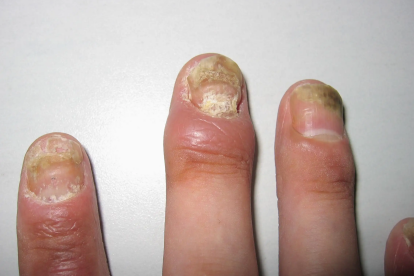 银屑病患者的指甲颜色