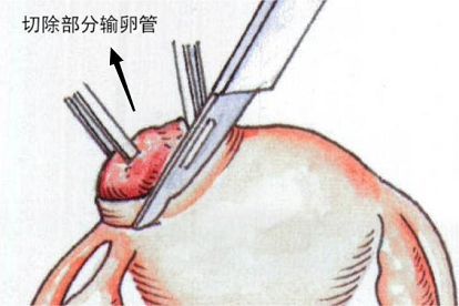 输卵管妊娠手术步骤图解