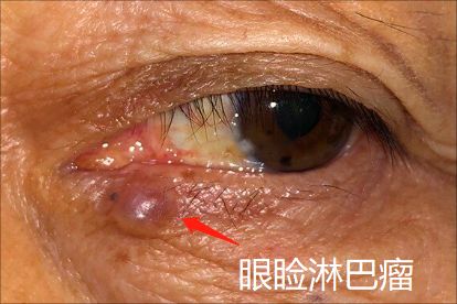 患者可能会出现眼睑肿大,皮肤溃破或者是皮肤渗液的症状