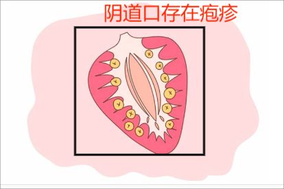 女性生殖疱疹发作症状图片